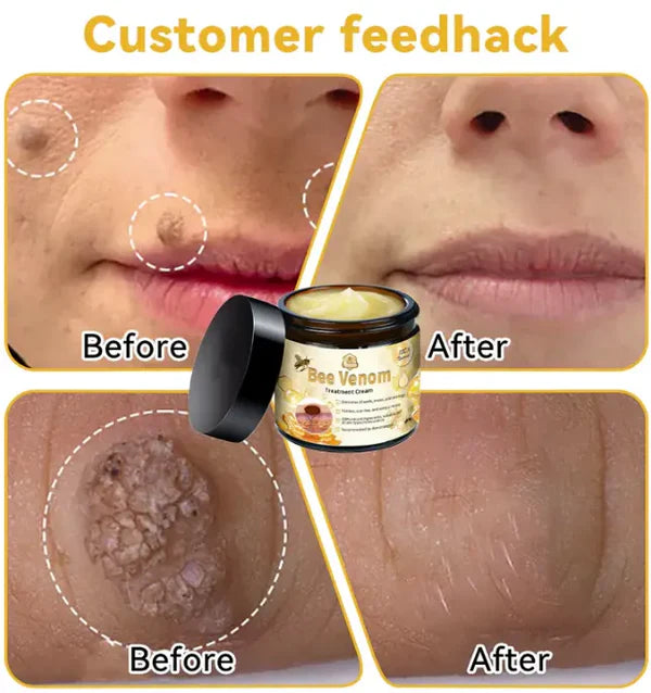 BEE VENOM ARTICULACIONES
